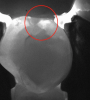 Fig 3. Caries confirmed through use of transillumination.