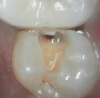 Fig 4. Open-tooth camera photograph confirmed caries exactly where it was displayed on transillumination image.