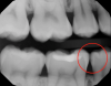 Fig 5. Possible insipient cares on tooth 
No. 29.