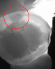 Fig 7. Under transillumination, a lesion was evident at DEJ.
