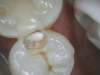 Fig 8. Open-tooth camera image showed the decay.
