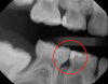 Fig 10. Decay evident, teeth J and K, on x-ray of caries-prone 6-year-old patient.