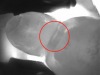 Fig 11. Transillumination image confirmed caries.