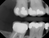 Fig 14. Pretreatment photograph, tooth No. 3.