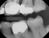 Fig 20. Pretreatment photograph, tooth No. 15 with either failing restoration or caries.