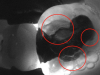 Fig 22. Transillumination revealed recurrent caries in three places at margins of the restoration.