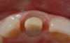 Fig 2. Prepared tooth and margin.