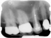 Figure 1  X-ray of an endodontically treated second bicuspid restored with a fiber post, core, and all-porcelain crown.