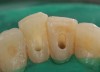 Figure 13  Access holes after endodontic treatment.