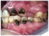 Fig 7 through Fig 9. This young patient’s only prosthetic option was extraction of all remaining teeth and subsequent placement of complete dentures.
