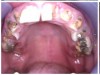 Fig 4 through Fig 6. Patient’s oral condition after 6 years of meth use.