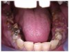 Fig 4 through Fig 6. Patient’s oral condition after 6 years of meth use.