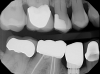 Fig 3. Inauthentic part on tooth No. 29.