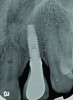 Fig 2. Radiograph of this same area. Note that there is no indication of bone loss and a long abutment collar. Hence, the diagnosis of peri-implant mucositis is given.