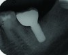 Fig 5. Radiograph of a mandibular left first molar implant in a 61-year-old man taken 2 years after the implant’s placement. No bone loss beyond physiologic remodeling has occurred.