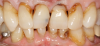 Fig 25. A 93-year-old man was unhappy with the appearance of his teeth.