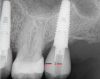 Fig 5. 2 mm is the distance of the implant platform from adjacent teeth.