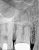 Fig 7. Preoperative radiographic image (Fig 7), preoperative CBCT (Fig 8), and postoperative radiographic image (Fig 9).