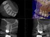 Fig 8. Preoperative radiographic image (Fig 7), preoperative CBCT (Fig 8), and postoperative radiographic image (Fig 9).