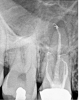 Fig 9. Preoperative radiographic image (Fig 7), preoperative CBCT (Fig 8), and postoperative radiographic image (Fig 9).
