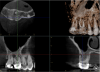 Fig 11. Preoperative radiographic image (Fig 10), preoperative CBCT (Fig 11), postoperative radiographic image (Fig 12), and 3-week recall radiographic image (Fig 13).