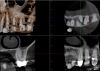 Fig 15. Preoperative radiographic image (Fig 14), preoperative CBCT (Fig 15), postoperative scans (Fig 16 and Fig 17), and inverted postoperative image (Fig 18).
