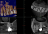 Fig 17. Preoperative radiographic image (Fig 14), preoperative CBCT (Fig 15), postoperative scans (Fig 16 and Fig 17), and inverted postoperative image (Fig 18).