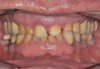 (2.) Pre-treatment anterior bite.