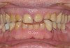 (4.) Postorthodontic anterior bite.