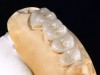 Fig 10. Lingual view of maxillary right posterior high-translucent zirconia restorations on the model.