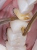 Fig 17. The APC-step C: application of dual-cure composite resin. Insertion of restorations and cleaning of excess composite material with a sable brush.