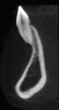 Fig 7. The CBCT sagittal view shows 4 mm tickness of bone on the lingual aspect of the affected tooth.
