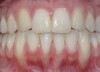 Fig 13. Clinical view of same patient 2 years after orthodontic treatment only, showing almost complete spontaneous root coverage.