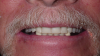Fig 1. Two implants are placed in the mandible, followed by two healing abutments.