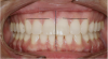 Figure 1  Dental midlines should be as close to coincident as possible. Gingival height of maxillary lateral incisors should be even with a line between the gingival height of the central incisor and canine to 1.5 mm below that line.