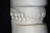 Figure 7A  This case is an example of the importance of evaluating the bite with the joints seated in a stable position. Orthodontic treatment was rendered to correct a "deep overbite" and trauma to the maxillary incisors. A) Handheld models in maximum intercuspation at beginning of treatment. The deep overbite is apparent.