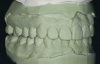 Figure 7B  This case is an example of the importance of evaluating the bite with the joints seated in a stable position. Orthodontic treatment was rendered to correct a "deep overbite" and trauma to the maxillary incisors. B) Handheld models showing correction of the deep overbite after orthodontics has been completed. The patient complained of "jaw" discomfort after orthodontic treatment.