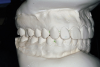 Figure 7D  This case is an example of the importance of evaluating the bite with the joints seated in a stable position. Orthodontic treatment was rendered to correct a "deep overbite" and trauma to the maxillary incisors. D) Models mounted in CR after retreatment.