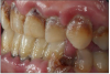 Figure 10. Dental caries.