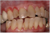 Figure 11. Periodontal disease.