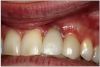 Figure 12. Dental implants.