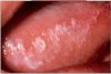 Figure 13. Leukoplakia.