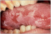 Figure 14. Oral cancer.