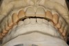 Fig 7. Complete diagnostic wax-up mounted in fully seated joint position. Note the Class II malocclusion unveiled once vertical dimension was restored and tooth proportions re-established. Horizontal overlap is excessive and can be overcome either by orthodontic camouflage, overcontoured prosthodontics, or moving teeth facially into augmented bone via SFOT. The latter approach allows for more ideal tooth positioning and minimally invasive dentistry.