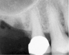 Figure 3  The osteotomy was completed with the 2.1-, 2.8-, and 3.5-mm twist drills without penetrating into the sinus.