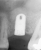 Figure 6  At site No. 14, a radiograph depicting the full "dome" of graft material apical to the implant.