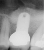 Figure 7  Radiograph depicting a "flattening" of the dome that has taken place in the first year after the graft was performed. This shows consolidation of the graft and remodeling that takes place over time.
