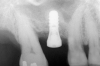 Figure 15  Implant successfully placed.