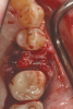 Fig 10. The deficient socket was grafted and the barrier trimmed and positioned over the bone replacement graft material, enabling ideal formation of the final ridge shape.