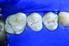 Fig 9. Dry the tooth surface again with compressed air for a minimum of 10 seconds. A properly etched surface appears white, dull, and frosty.